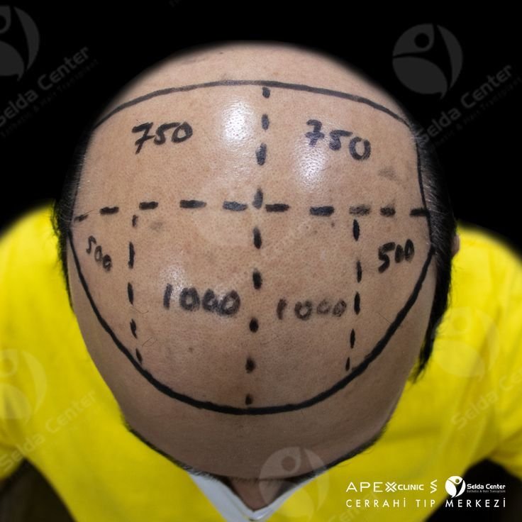 Durga Hair Transplant (9)